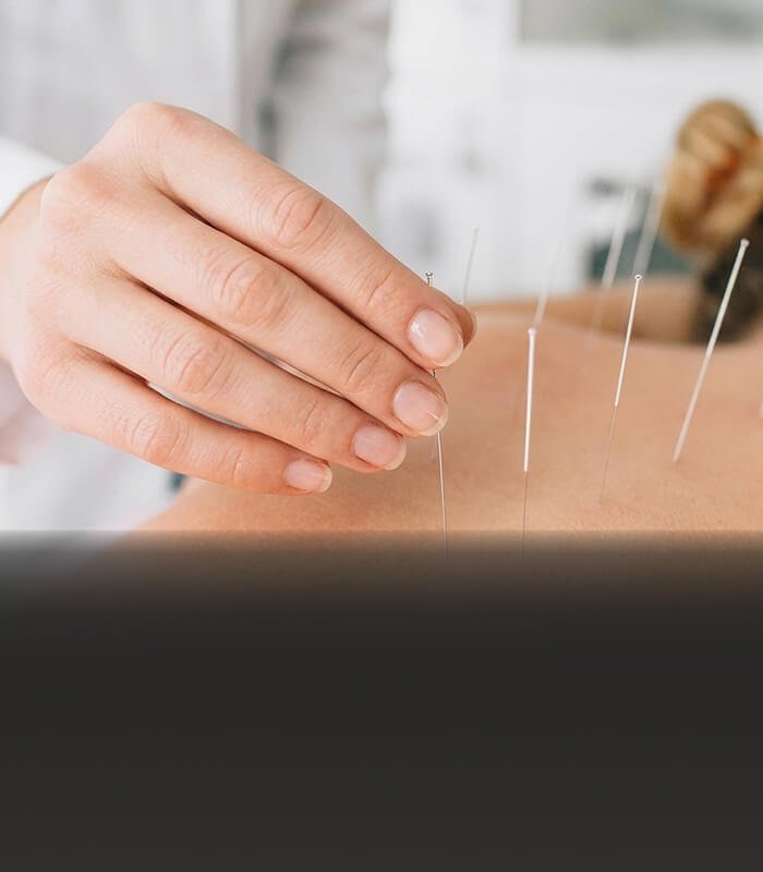 2-Dry-Needling