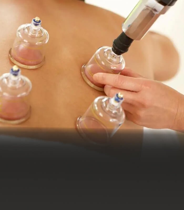 Cupping-Therapy