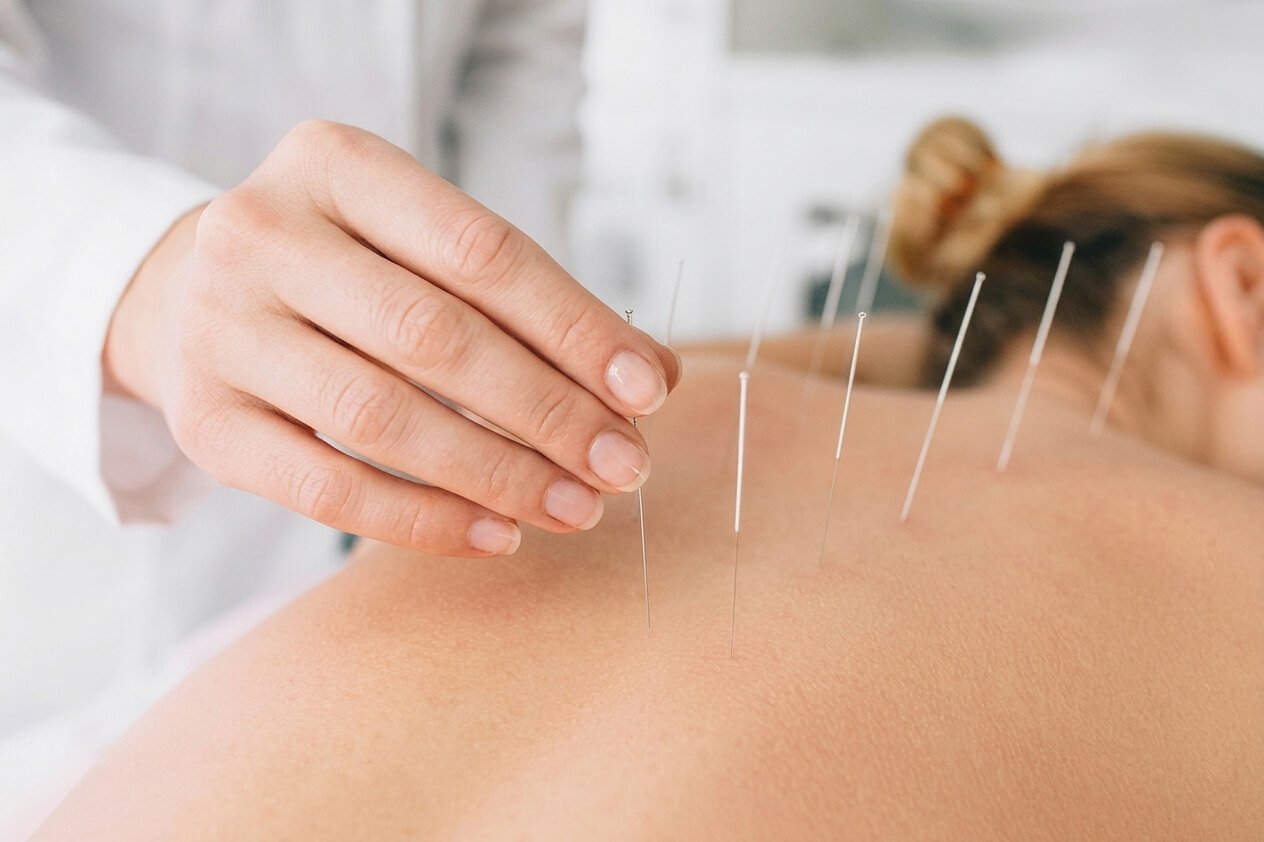 Dry-Needling-lamia